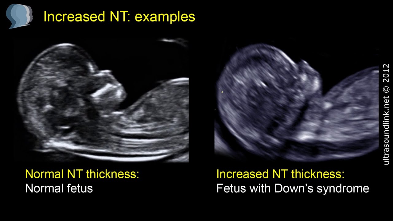 Nuchal translucency (NT)