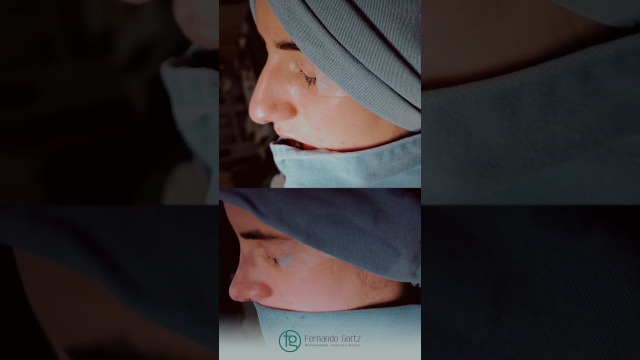 A Fantástica Rinoplastia, também conhecida como cirurgia plástica no nariz Dr. Fernando Gortz