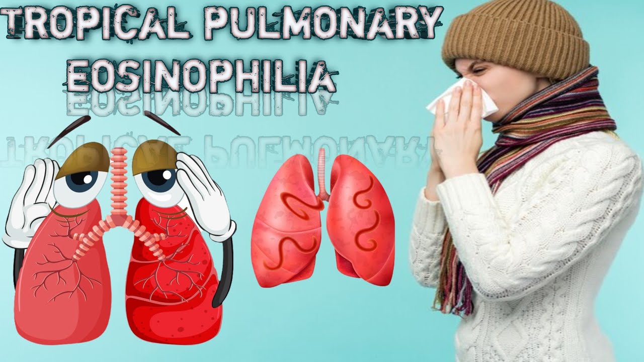 شرح Tropical pulmonary eosinophilia