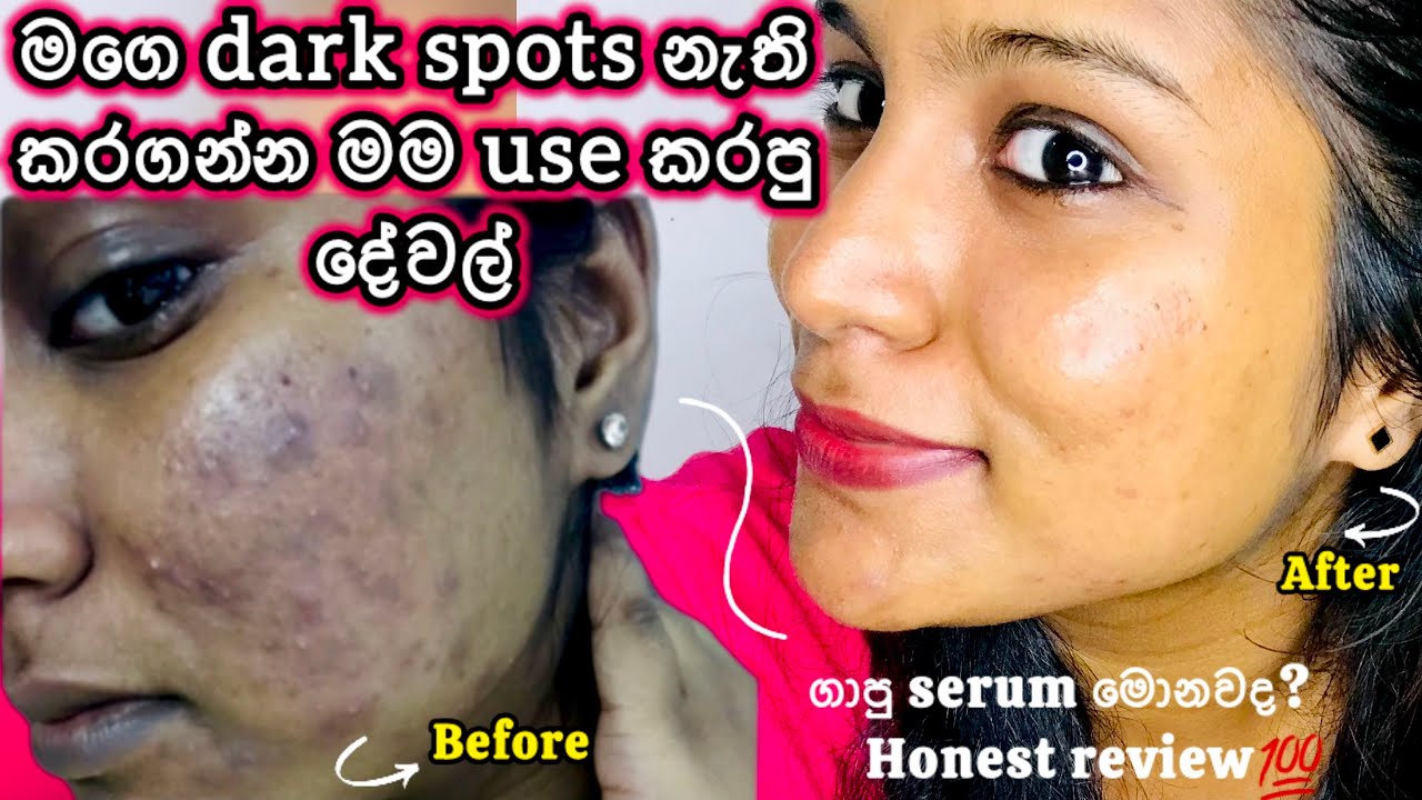 Pimple marks, Dark spots නැති කරගන්න මම use කරන product |Best serum මොනවද ?|#vlog#skincare#glassskin