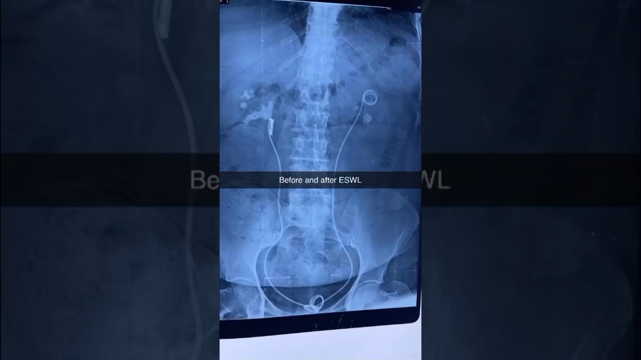 Magics of ESWL | kidney stone treatment | lithotripsy #medical #kidneystone