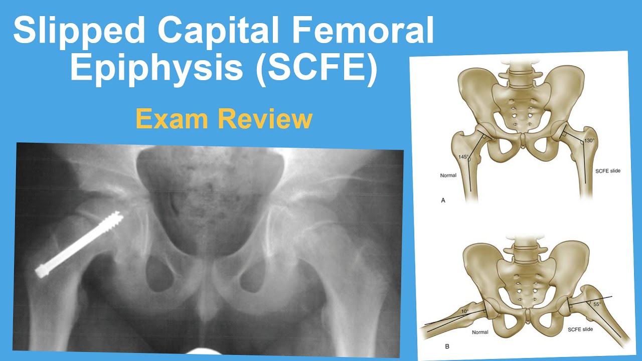 Slipped Capital Femoral Epiphysis Exam Review - Rachel Goldstein, MD