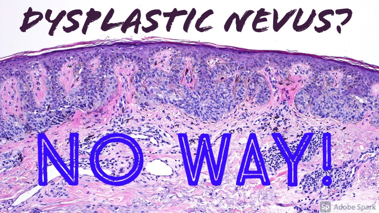 Melanoma (Lentigo Maligna Type) vs Dysplastic Nevus: 5-Minute Pathology Pearls