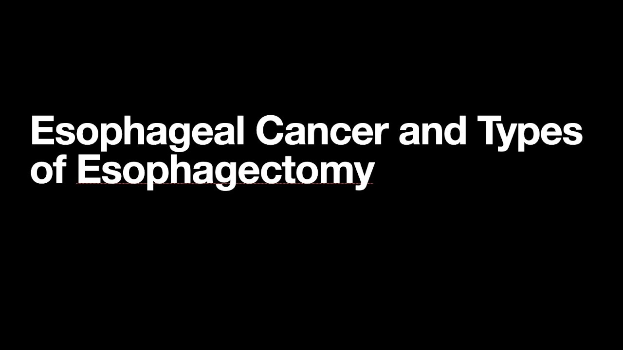 The Three Types of Esophagectomy
