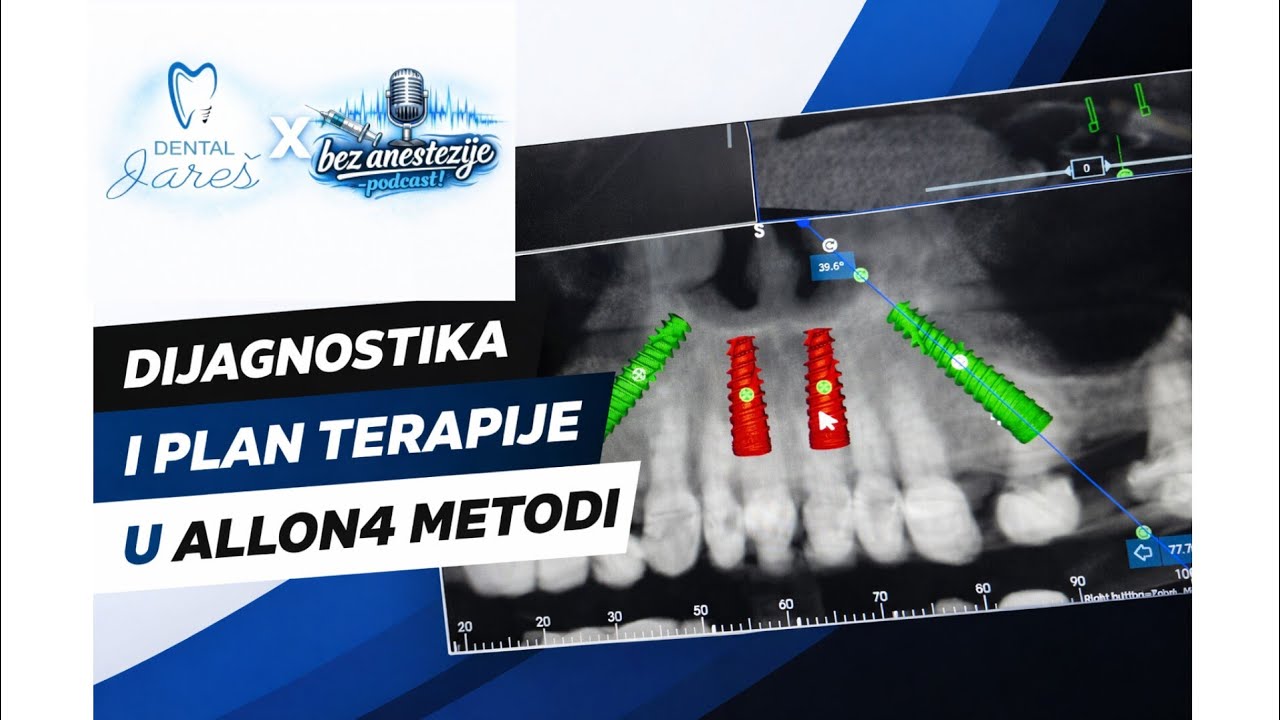 Zašto je dijagnostika i plan terapije ključ uspjeha u implantologiji | Dr. Igor Jareš