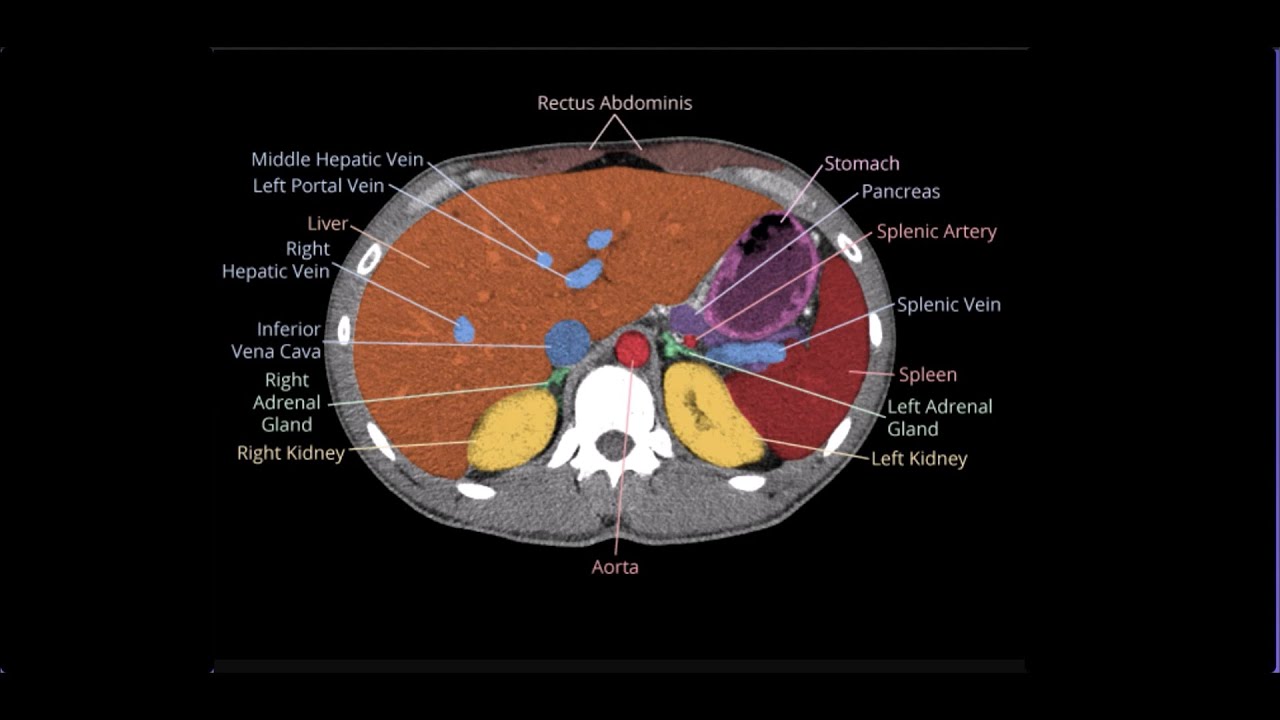 Normal Abdomen anatomy on a CT Scan Simplified: Real CT Images | Radiology Illustration