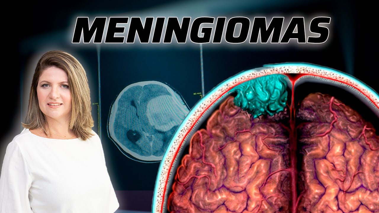 MENINGIOMA... é sempre benigno?