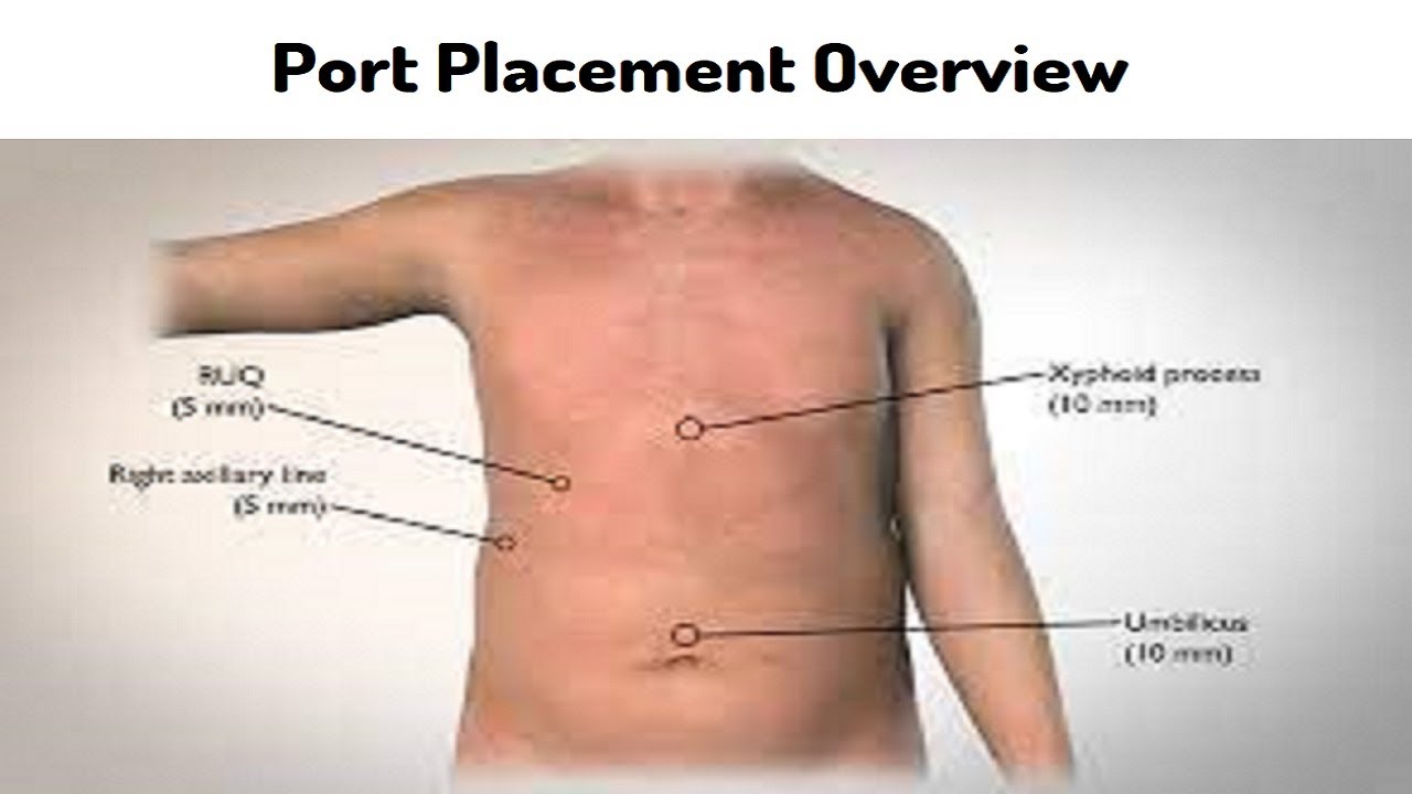 Port Placement Overview | 5 Ways to Properly Place a Port