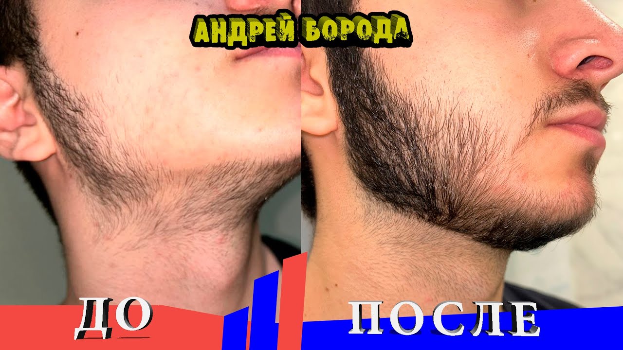 Борода в 15 лет / Это для роста Волос и Бороды / Как отменять Минокс / ВЫПУСК №5 / Андрей Борода