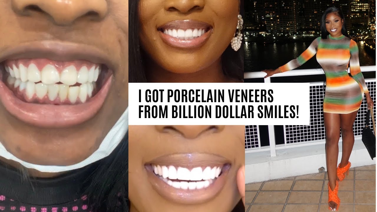 VENEER VLOG BILLION DOLLAR SMILES NO DAMAGE TO REAL TEETH