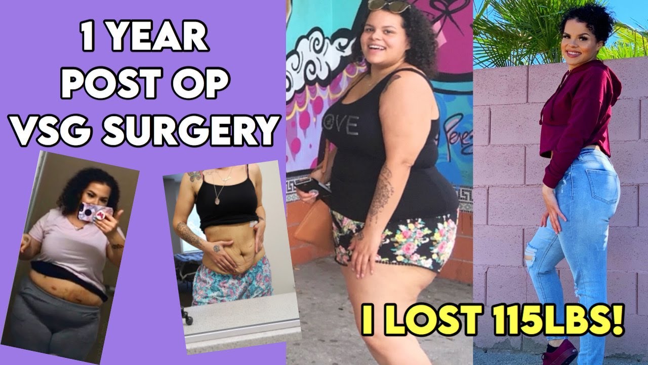 Life After VSG: 1 Year Post Op Update | Loose Skin | Before + After Pics