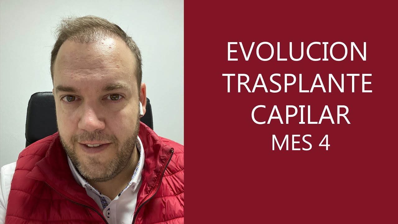 Evolución Trasplante capilar en Turquía - 4 meses