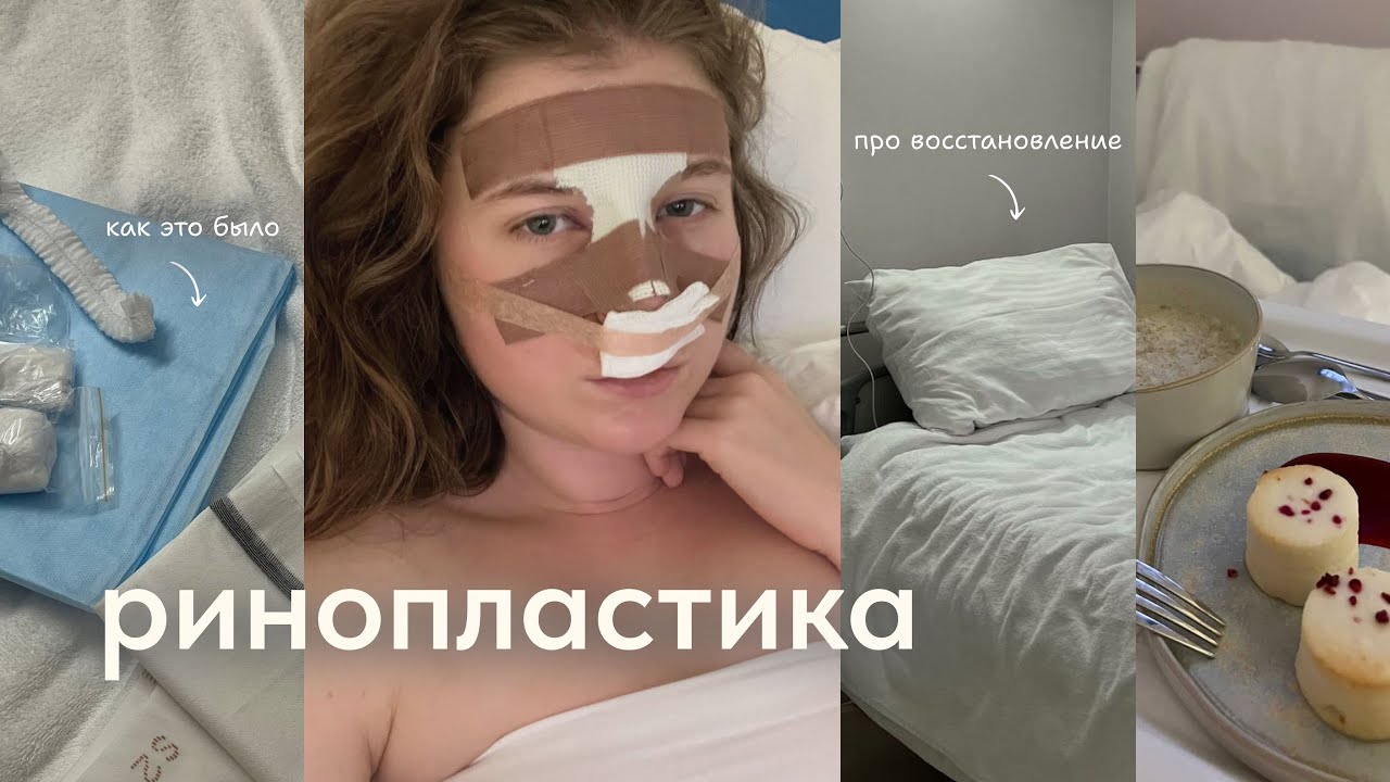 Ринопластика | Этапы, восстановление, результат спустя 14 дней