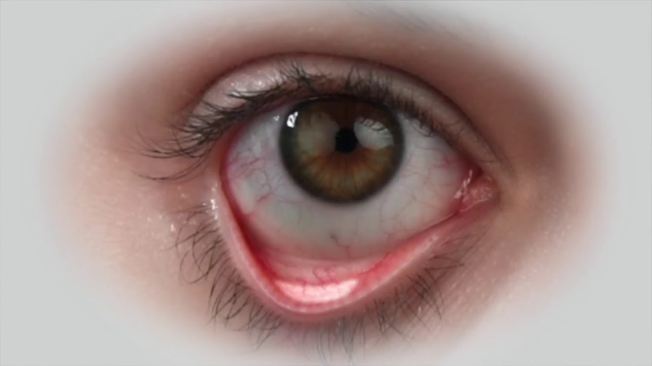 Introducing the IPEN Tear Film Osmolarity System