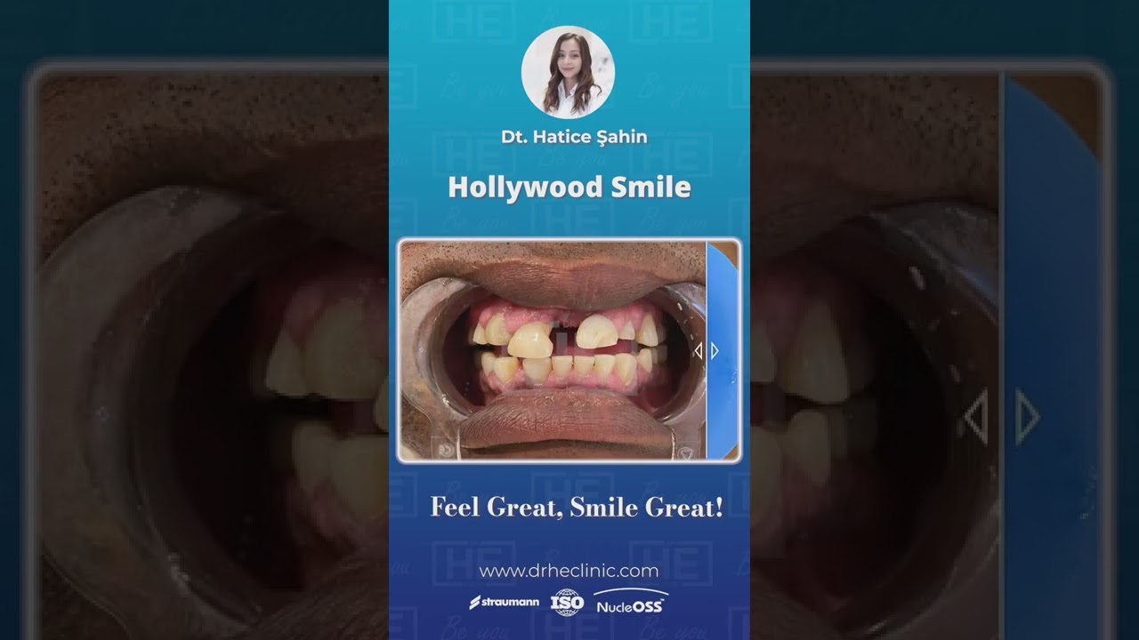 Are you ready for a Hollywood Smile? Change your smile! #shorts