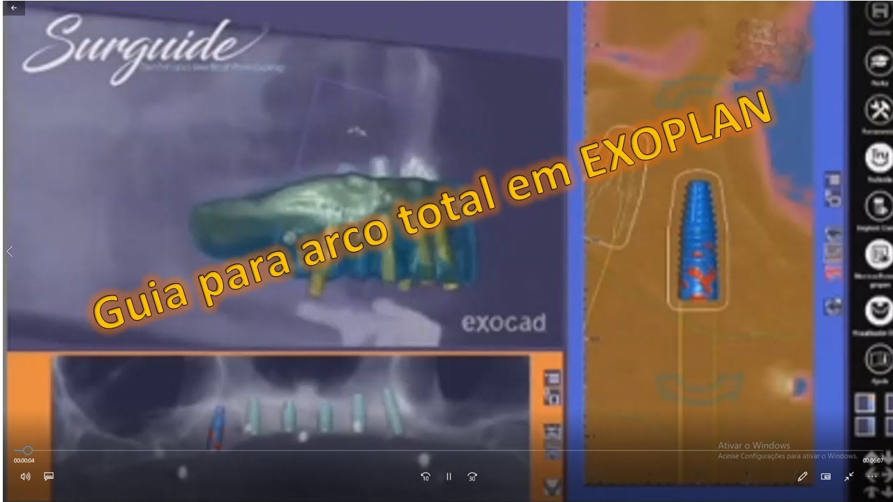 TUTORIAL: Como fazer guias cirurgicos para arco total utilizando o software EXOPLAN