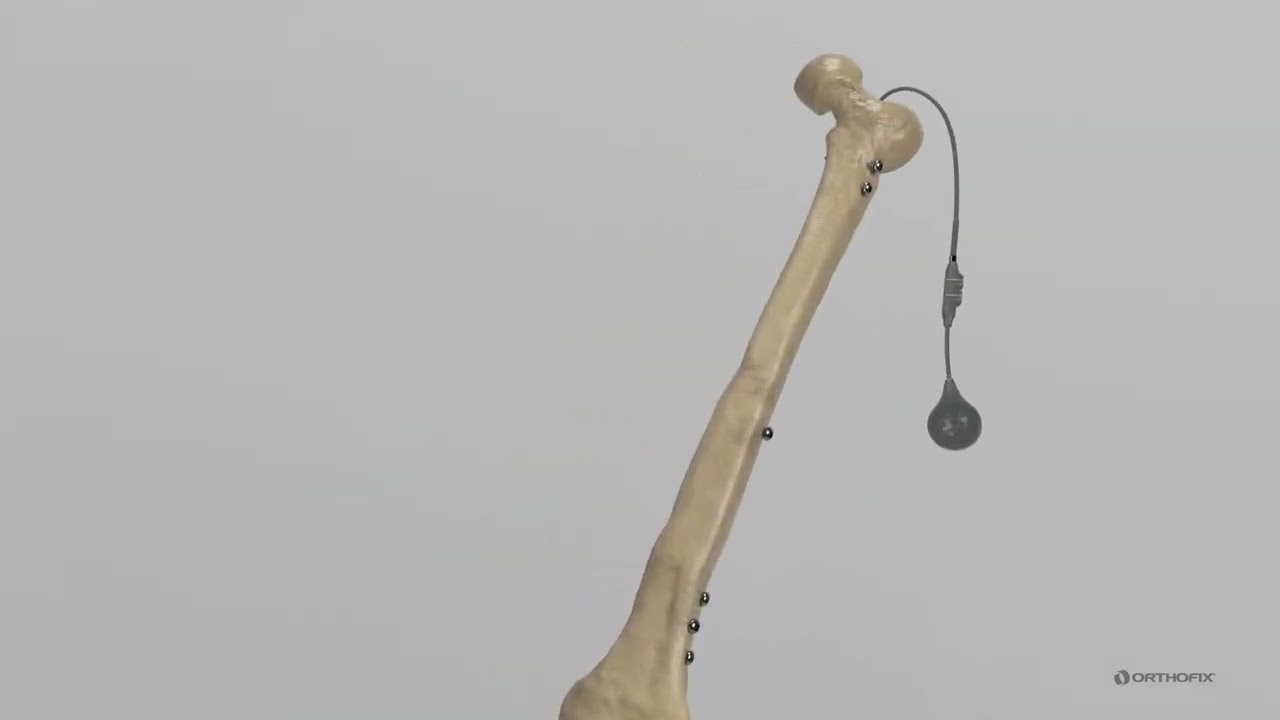 Fitbone Transport and Lengthening System