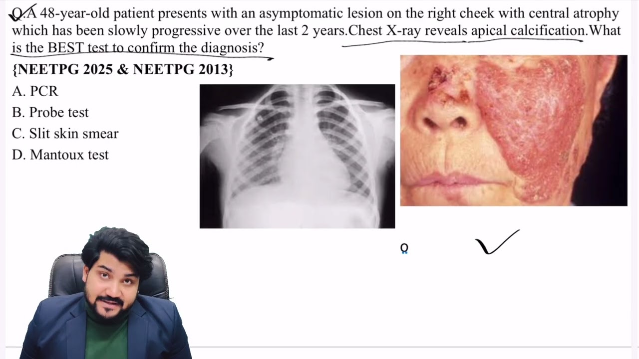 Lupus Vulgaris Made Easy | Dermatology + Microbiology Integration| INI-CET & NEET-PG|