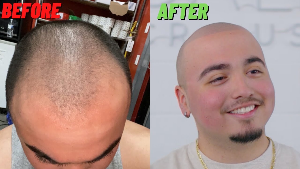 BARBERSHOP Style Scalp Micropigmentation Result in Los Angeles, California