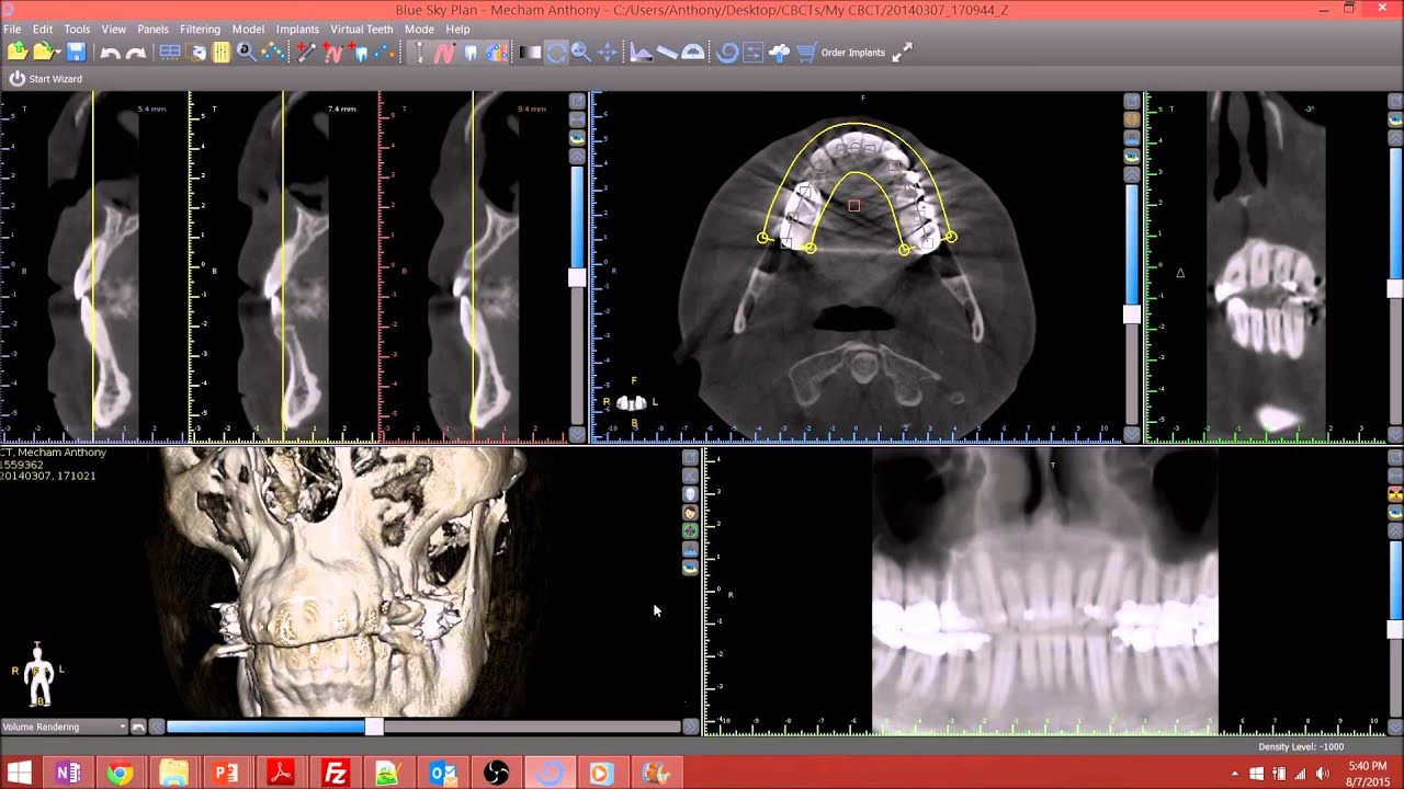Blue Sky Plan Cone Beam CT Implant Planning Software