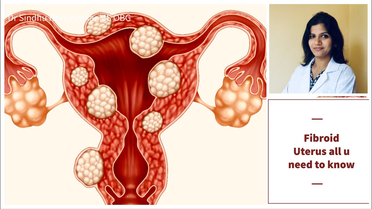 Signs and Symptoms of Fibroid Uterus | Explained in Kannada | Dr Sindhu Ravishankar
