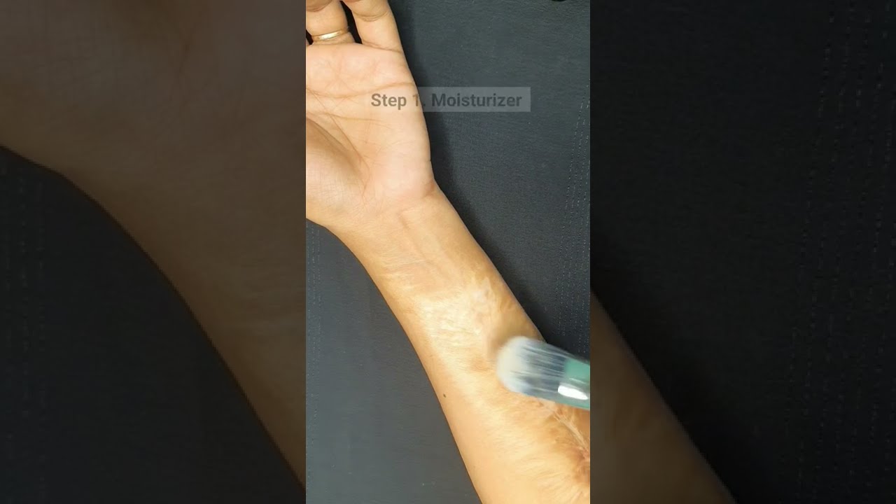 How to do makeup on white scars, Acid burn & vitiligo skin 
