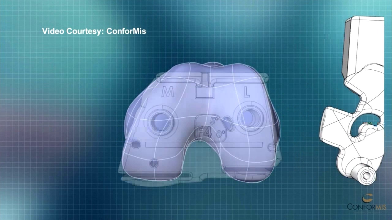 3D Knee Replacement