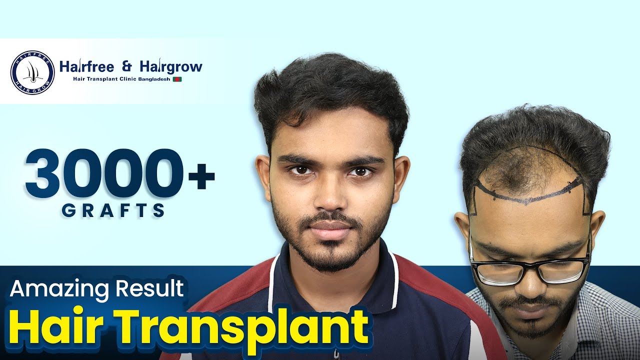 8 Month Hair Transplant Journey | 3000 Grafts | Grade 3 Baldness | Hairfree & Hairgrow Bangladesh