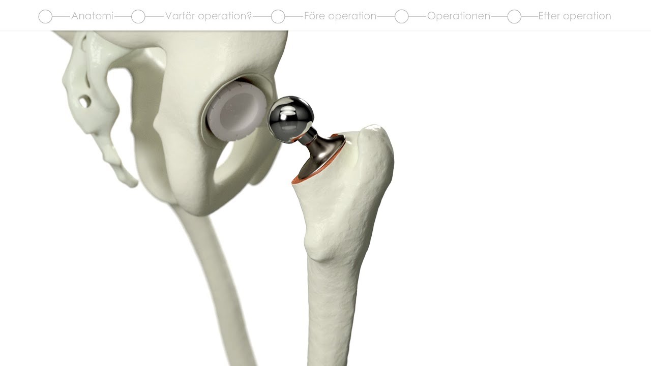 Patientfilm om höftledsplastik