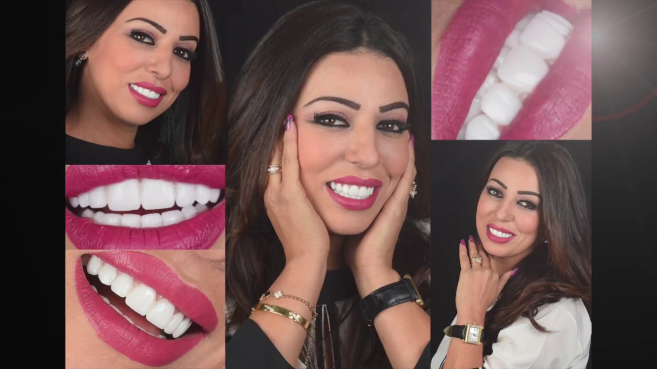 Hollywood Smile ( facettes dentaires) en 2 rendez-vous par New Smile Maroc