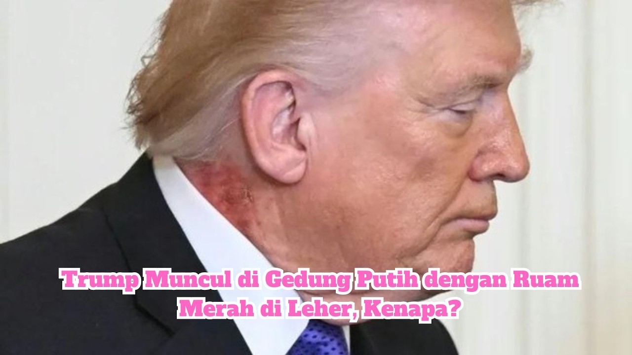 Trump Muncul di Gedung Putih dengan Ruam Merah di Leher, Kenapa?