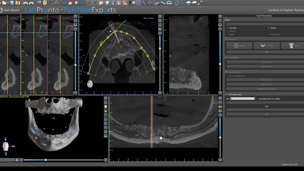 How to evaluate for an Anterior Loop and the Risk of Mid-line Implants