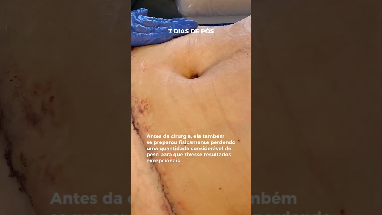 Cirurgião Plástico mostra: resultado da lipo abdominoplastia da nossa paciente #cirurgiaplastica