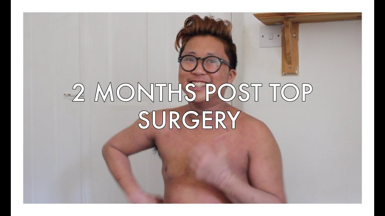 2 Months Post Top Surgery