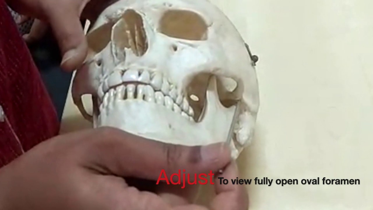 Gasserian ganglion Trigeminal block - made simplified by demo on the skull