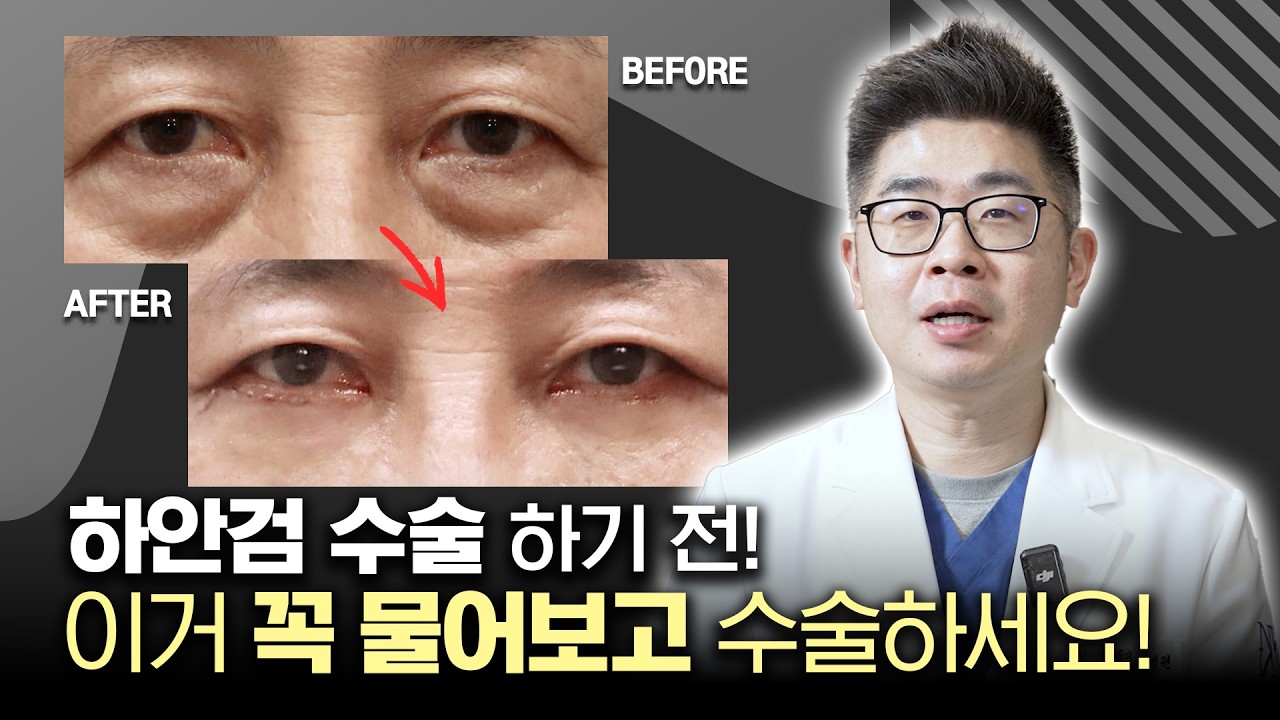 하안검 수술 하기전, 꼭 물어보고 수술하세요!
