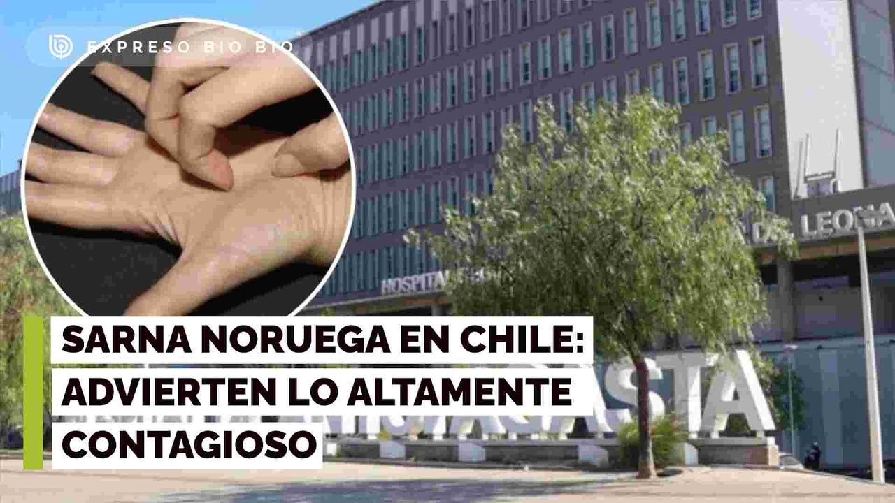 Sarna noruega en Chile: Advierten lo altamente contagioso y el peligro en personas inmunodeprimidas