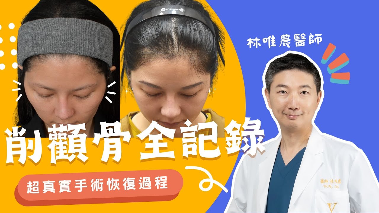 骨頭不用削！顴骨內推手術超真實記錄！｜林唯農醫師的顱顏教室