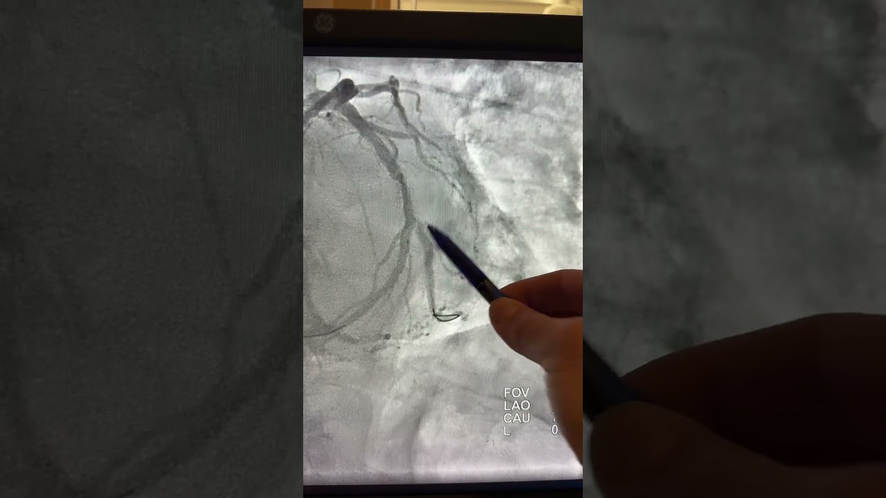 High risk PCI, when a small 1.5 mm balloon wont pass through struts! A complex bifurcational ISR.