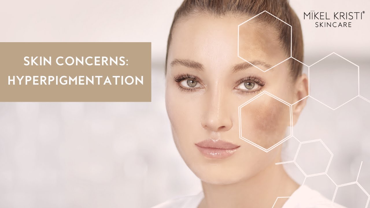 Hyperpigmentation