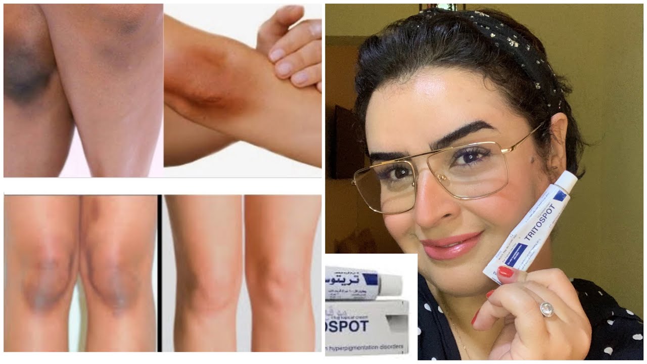 تريتوسبوت/افضل حل ضد اثار الحبوب على الوجه/تبيض ركب/طريقة صحيحة ونصاءح الاستعمال /