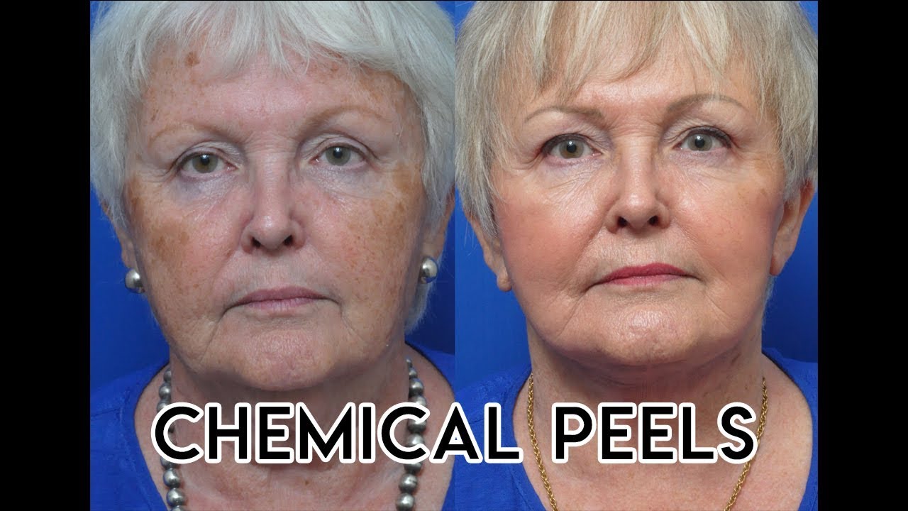 Chemical Peels