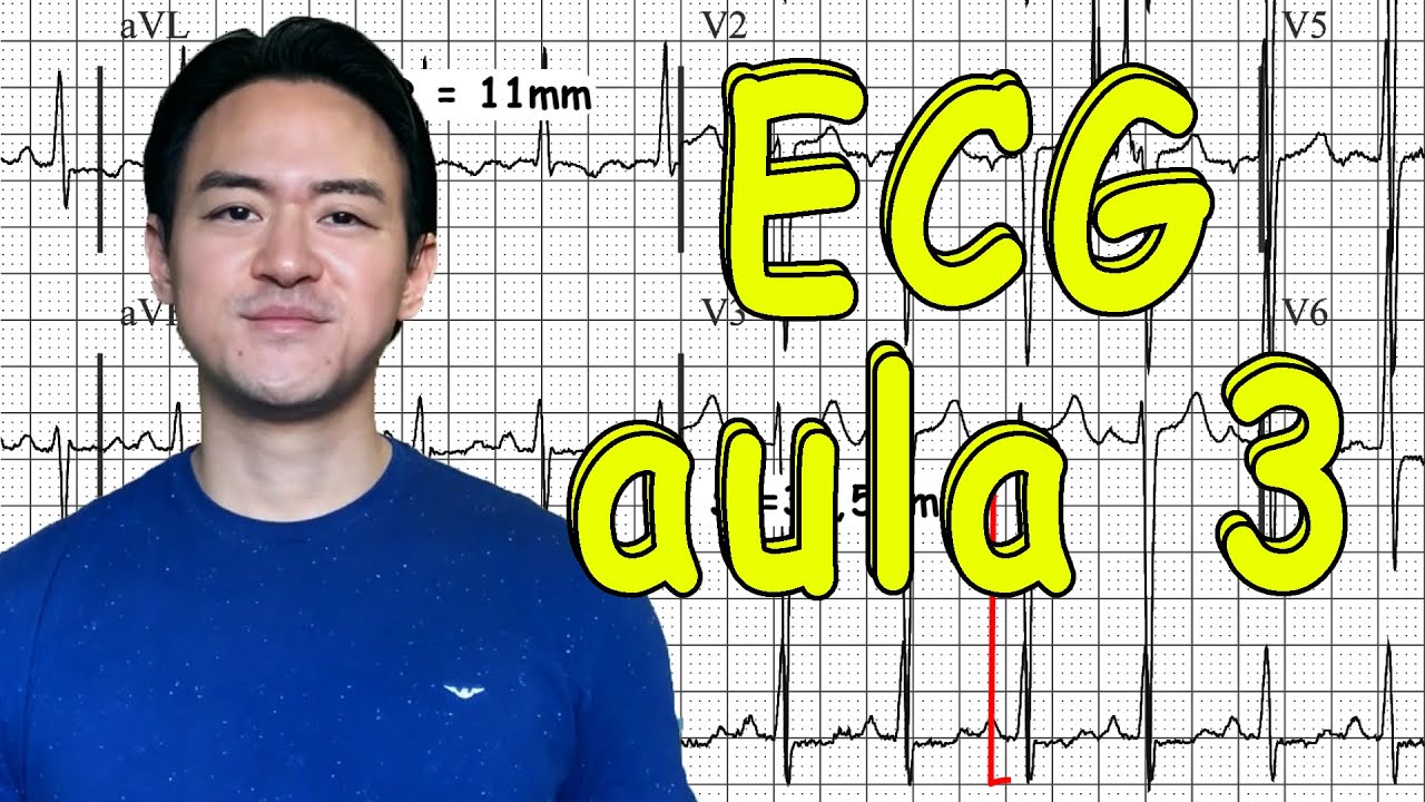 ECG aula 3 - complexo QRS