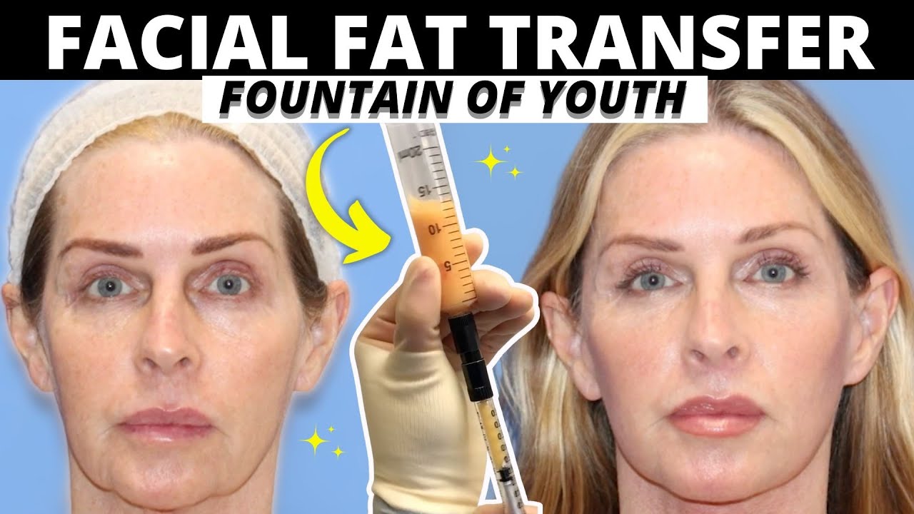 BIGGEST Facial Fat Transfer Myths!
