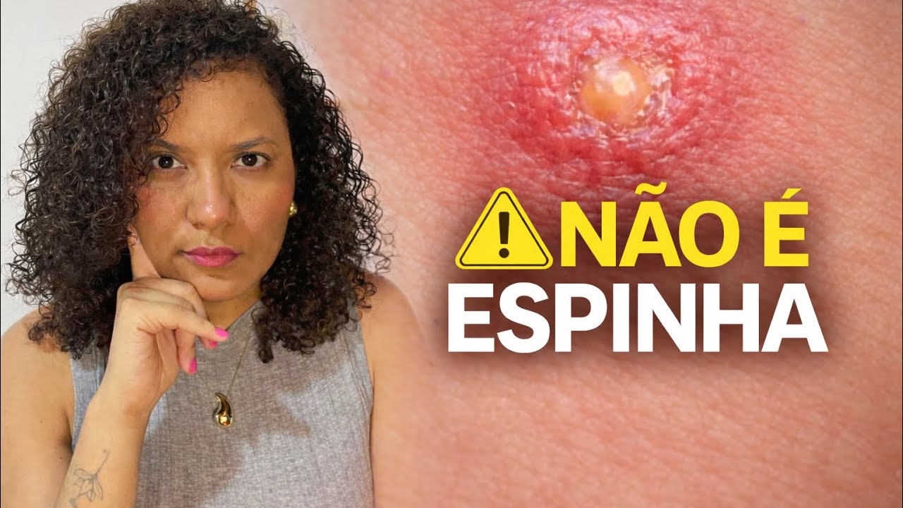 5 sinais de MPOX e que você consegue VER 👀 | Infectologista Explica 