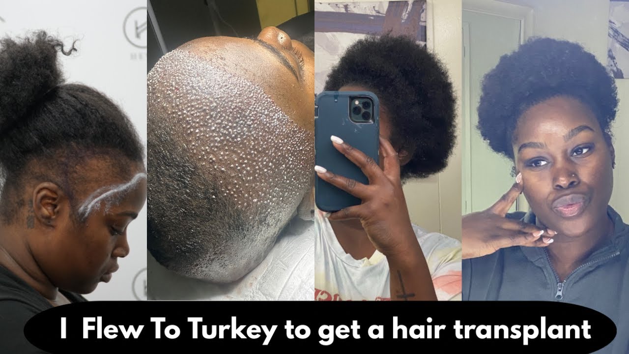 I FLEW TO TURKEY TO GET A HAIR TRANSPLANT | HEVA CLINIC | BLACK WOMEN  | FUE | MY JOURNEY | MY STORY