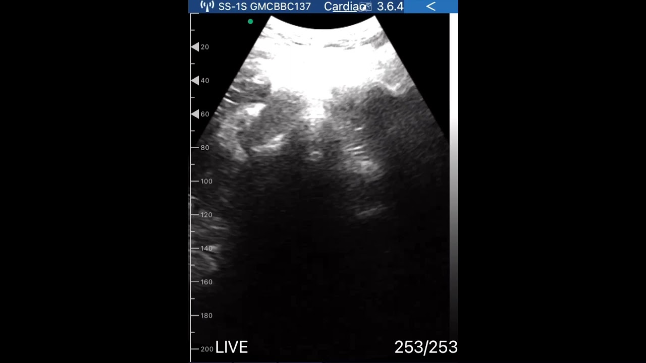 Echo Of My Heart During Breath Holds