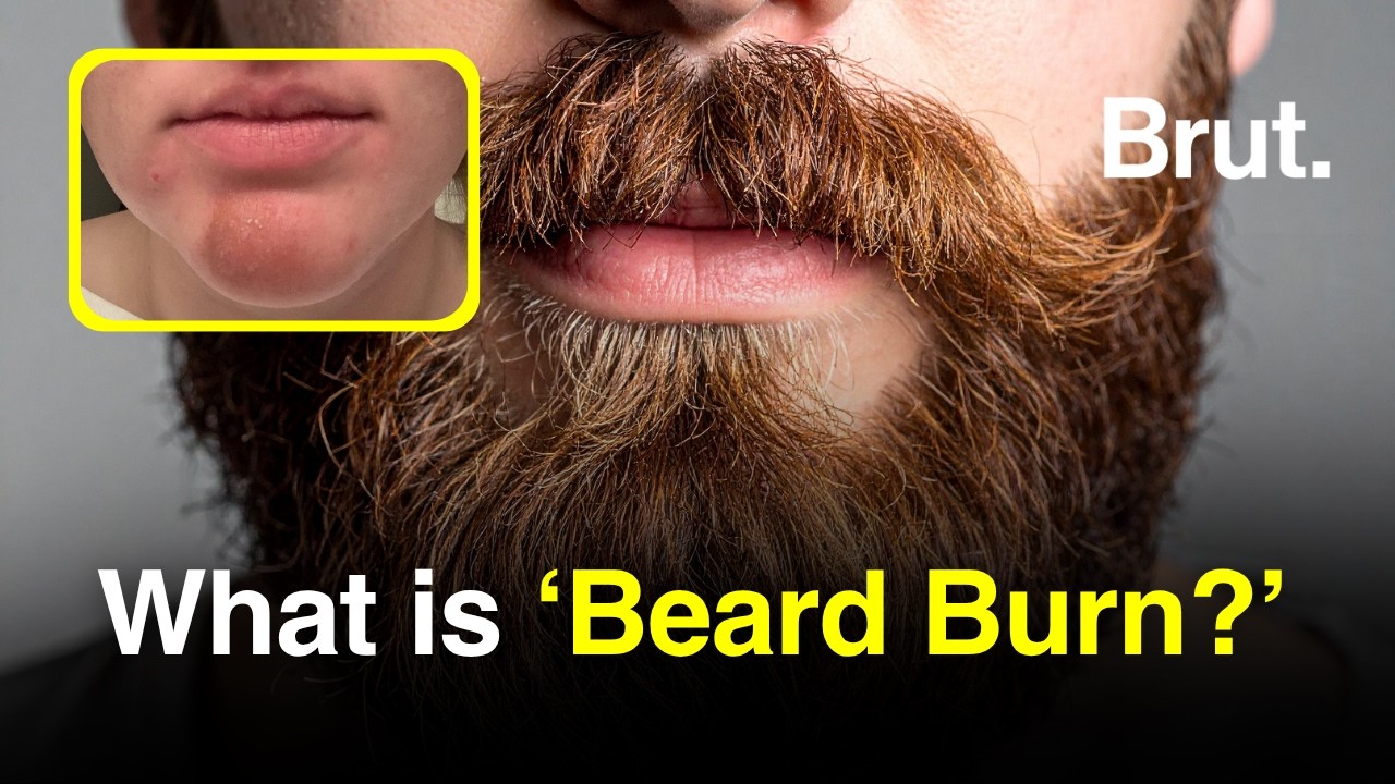 What is Beard Burn?