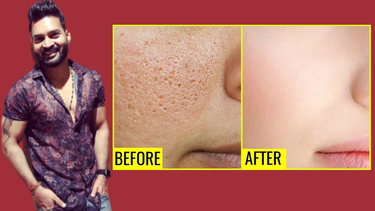 Reduce OPEN PORES NATURALLY. Diet Explained