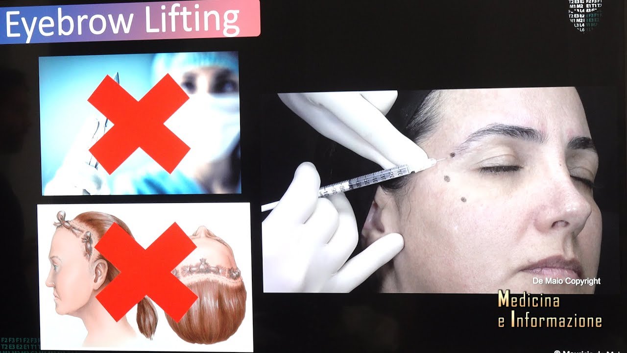 Il lifting non chirurgico con fillers infiltrativi di ultima generazione